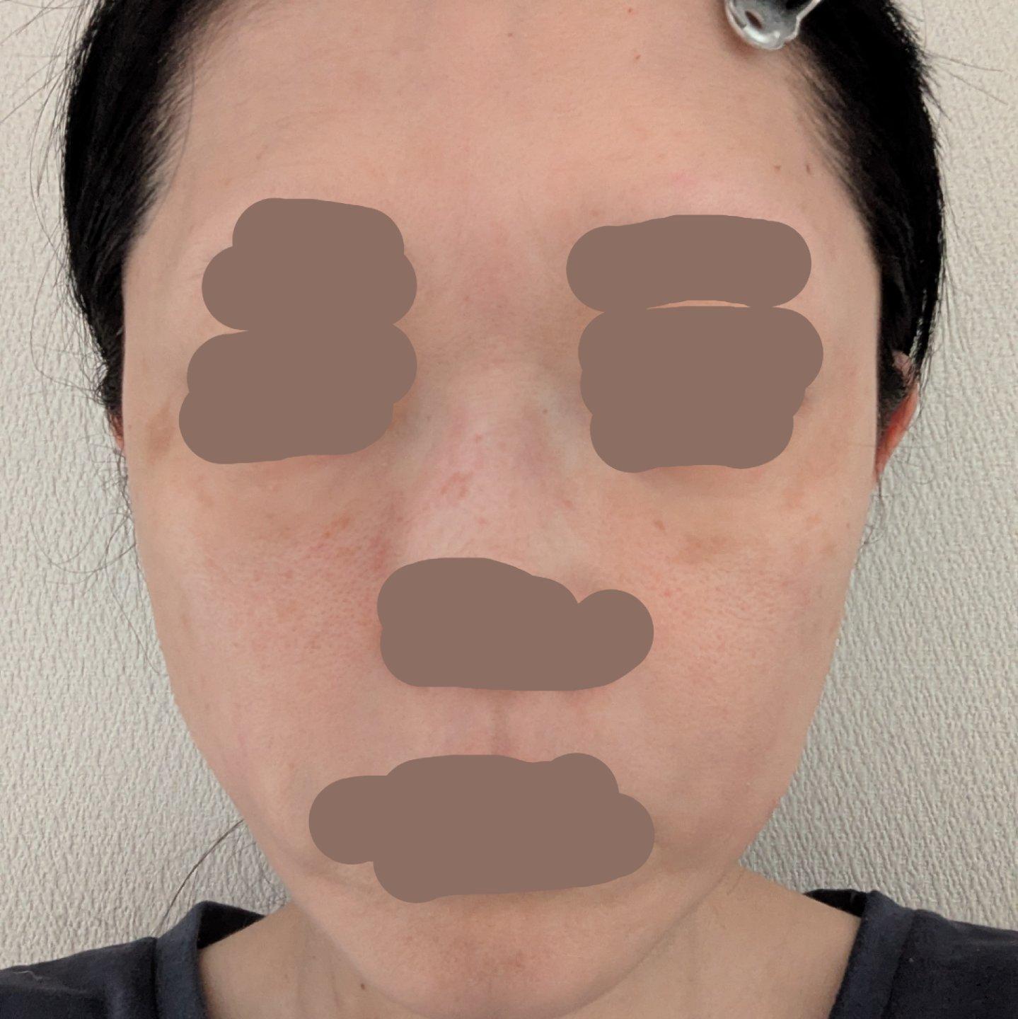 在 FlowMD 做了PicoSure 皮秒激光，真实分享✨ 1