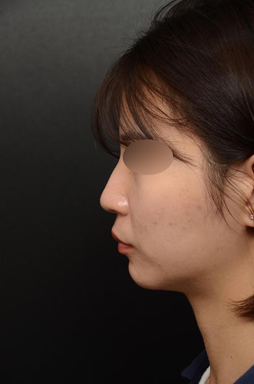 My Rhinoplasty experience at FlowMD ✨ 1