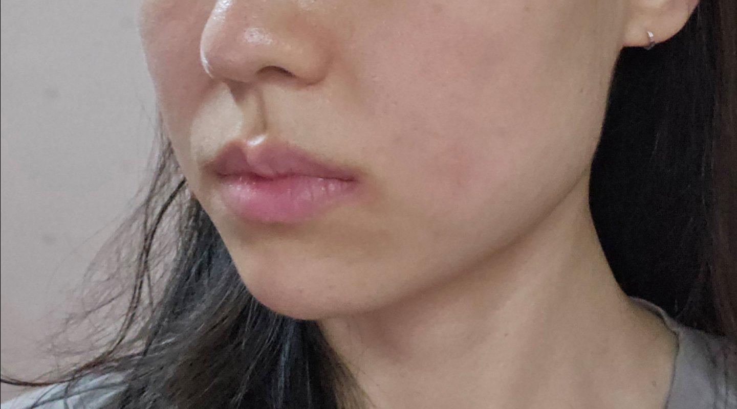 Finally tackled nasolabial folds and early jowls with Fotona 4D 1