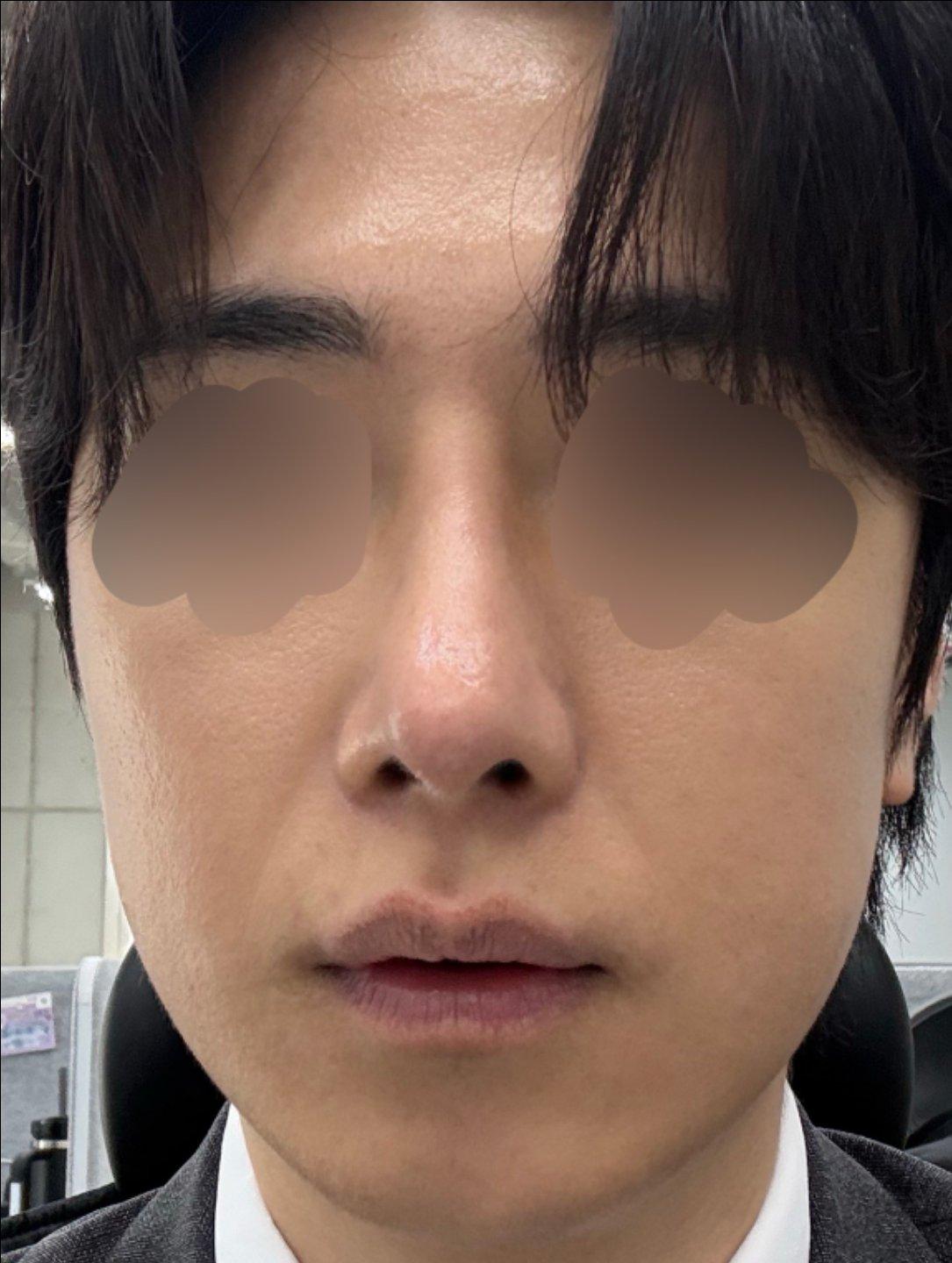 My profile is straight and the tip is refined but natural — so glad I did Rhinoplasty 3