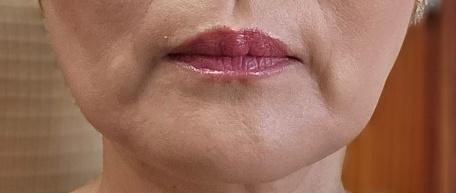 A few weeks after Hyaluronic Acid Fillers 🙌