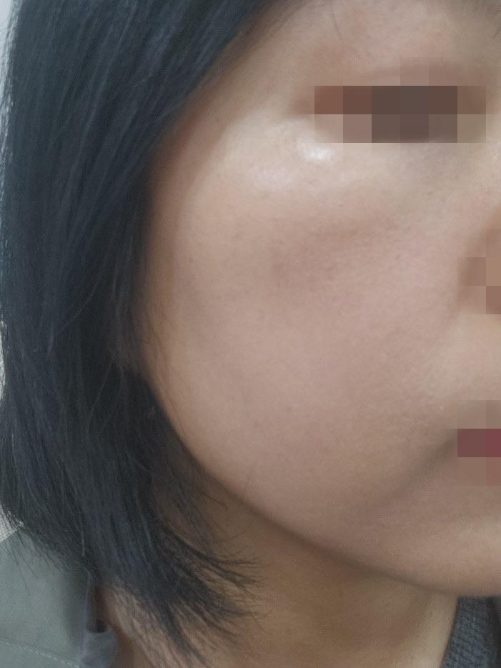 My Sculptra experience ✨