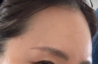 A few weeks after Botox 🙌 1