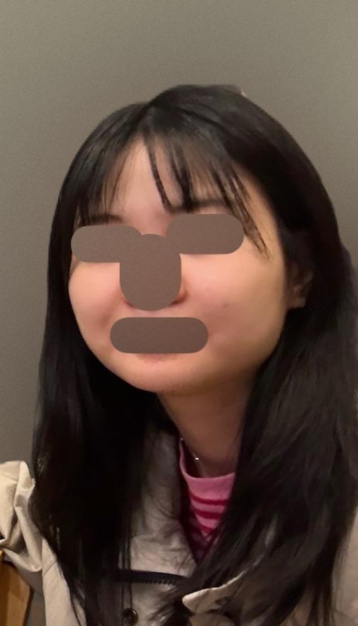 Finally tackled fine lines and a wide jaw with Xeomin 1