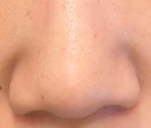 My skin looks lit-from-within and firmer — so glad I did 5D Collagen Lift