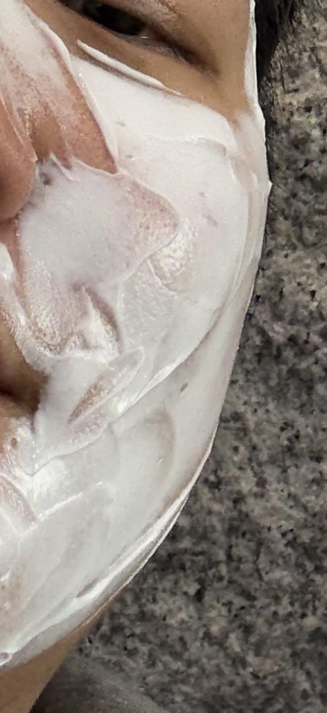 My scars are visibly shallower and my skin feels smooth — so glad I did CO2 Ultrapulse Alpha