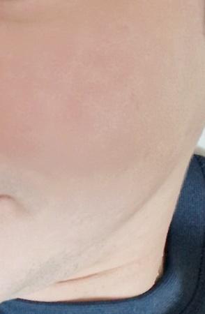 My pores look refined — so glad I did ResurFX 1