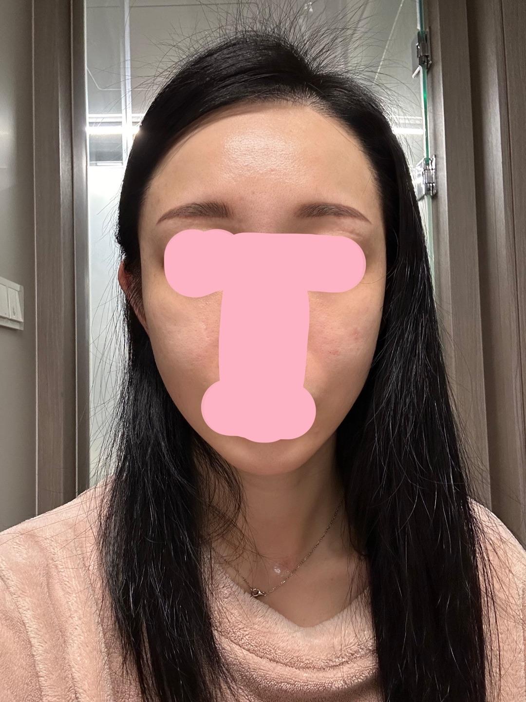 A few weeks after AccuTite/FaceTite 🙌