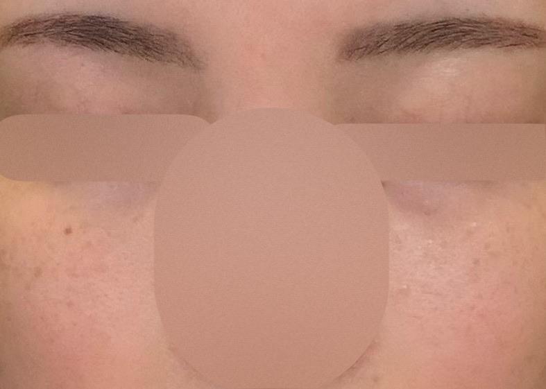 Finally tackled big pores and acne scars with ResurFX 1