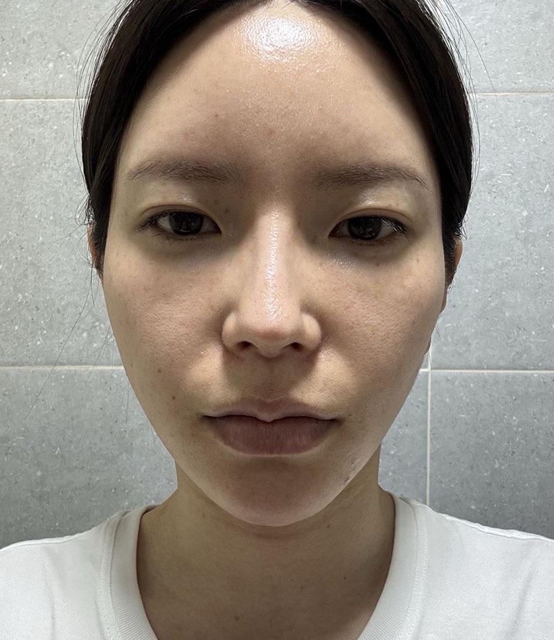 My Sculptra experience ✨