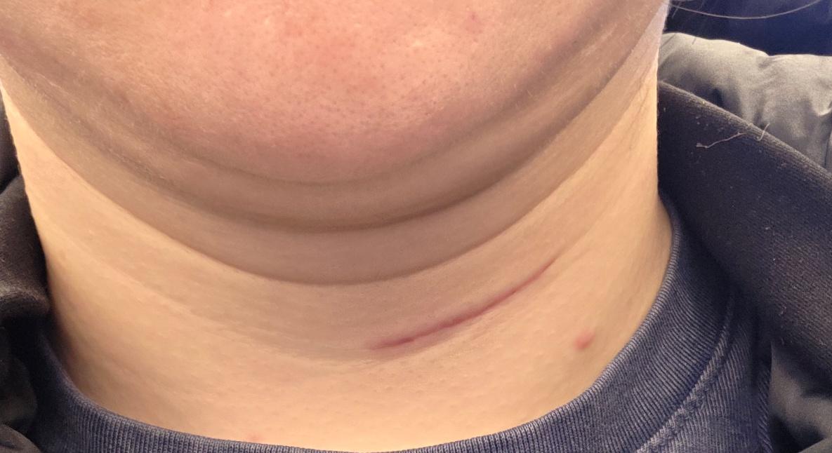 Finally tackled deep acne scars and rough texture with CO2 Ultrapulse Alpha