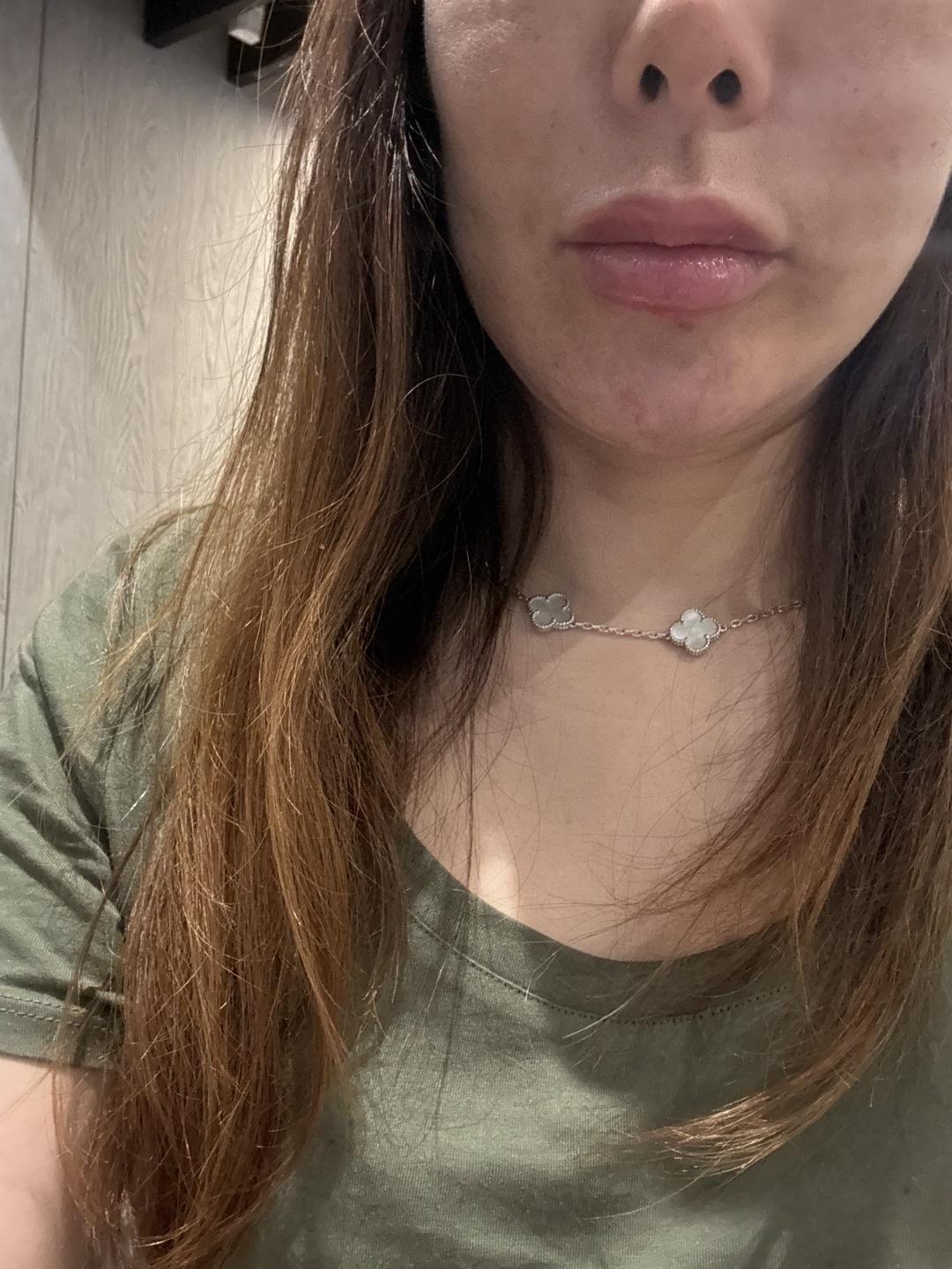 Finally tackled thin lips and flat cheeks with Hyaluronic Acid Fillers
